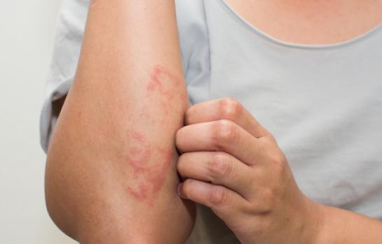 Psoriasisalergiapiel-sensible_EDEIMA20170221_0003_1.jpg