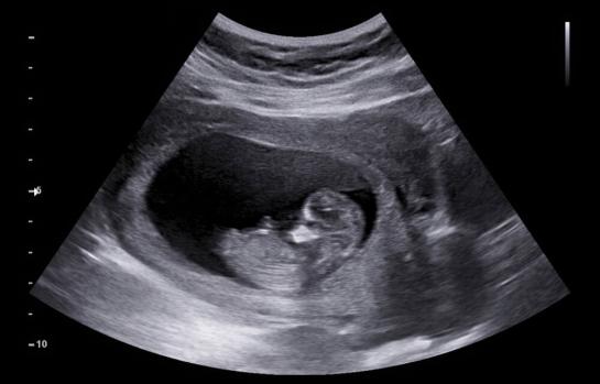 Interrupción voluntaria del embarazo CM_img